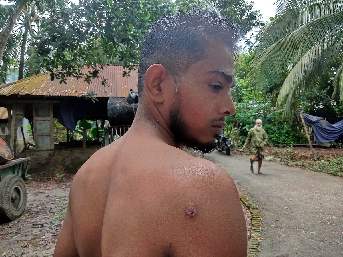 নারায়ণগঞ্জের চিটাগাং রোডে মিছিলে যোগ দিলে তিনটি রাবার বুলেট ও একটি মেটাল বুলেট জসীমের হাত, পিঠ ও কোমরে বিদ্ধ হয়। এখন অর্থাভাবে তিনি চিকিৎসা করাতে পারছেন না